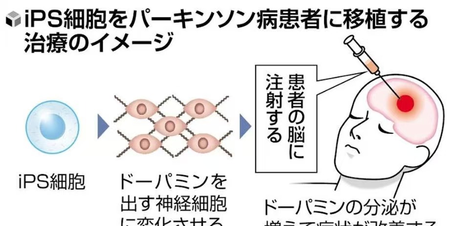 日本厚生劳动省附条件批准iPS细胞来源帕金森再生医疗产品AMCHEPRY上市